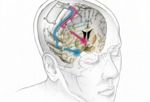 Implante Cerebral