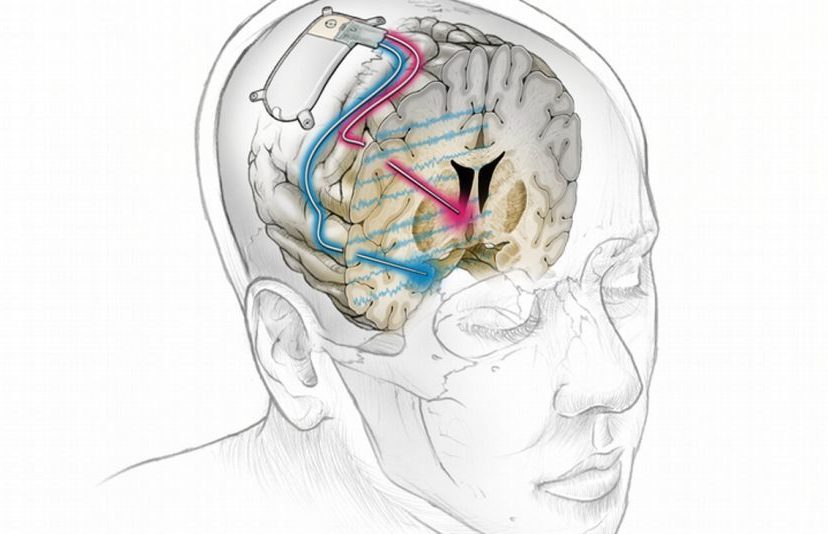 Implante Cerebral