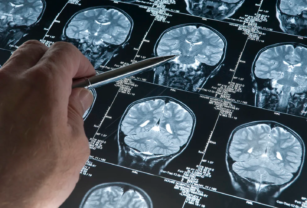 Alzheimer - Covid