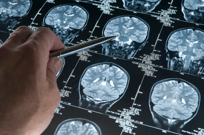 Alzheimer - Covid