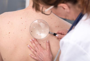 Vacuna cáncer de piel melanoma