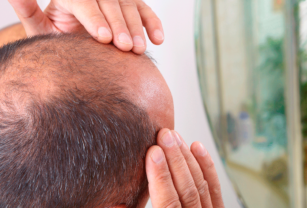 Alopecia