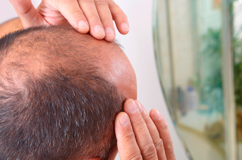 Alopecia