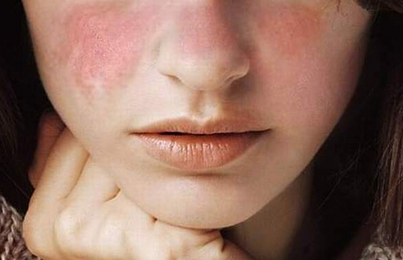 lupus