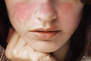 lupus