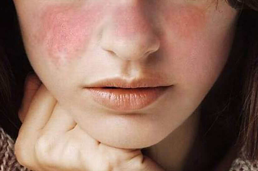 lupus