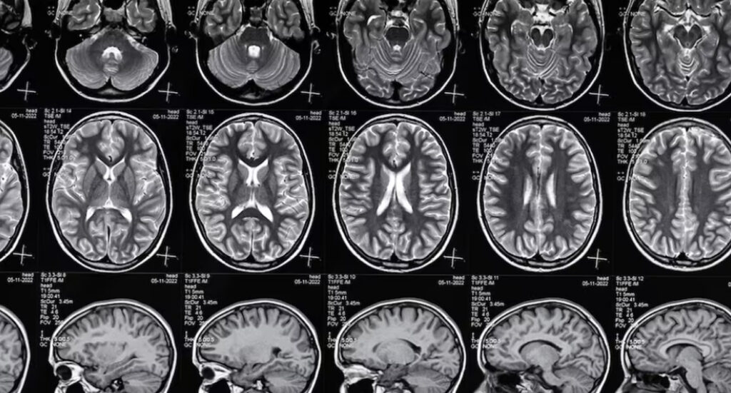 alzheimer