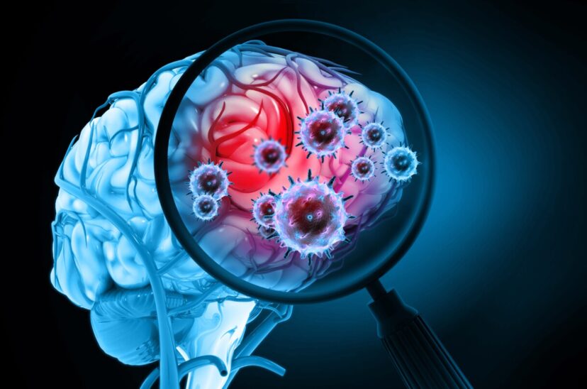 Meningitis fúngica