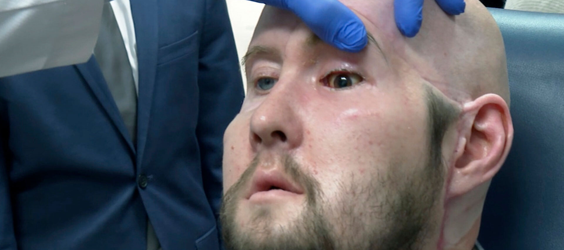 trasplante de ojo
