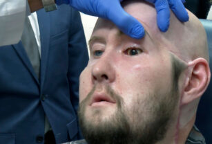 trasplante de ojo