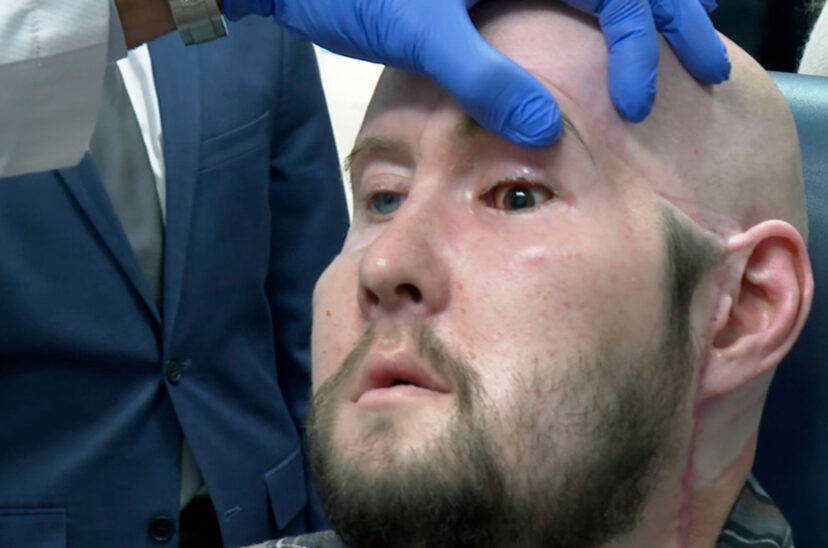 trasplante de ojo