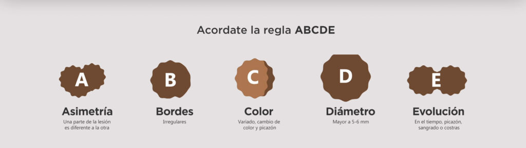 Regla ABCDE. Imagen: Campaña Nacional de Prevención del Cáncer de Piel.