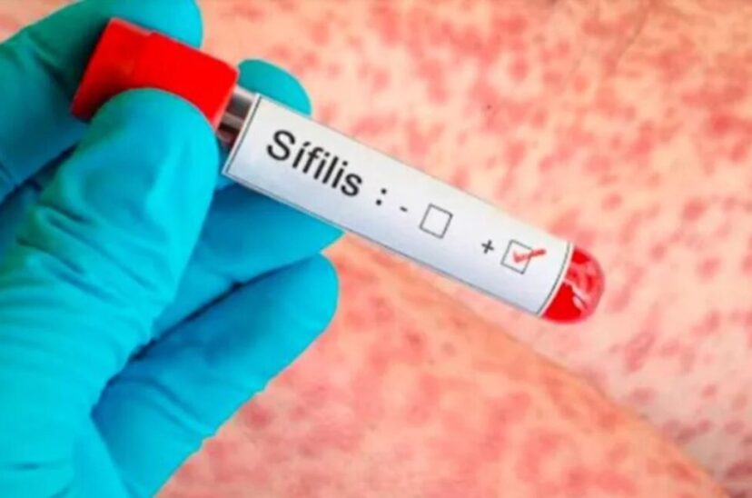 Sífilis