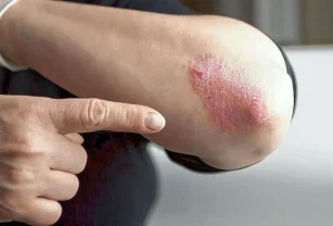 psoriasis